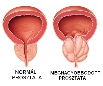 Prostatitis A Groin hernia miatt