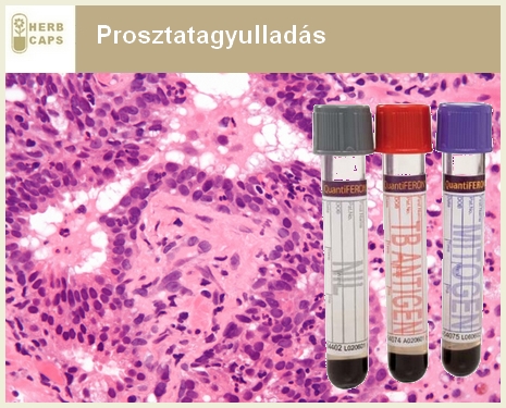 prostatitis | railpixel.hu